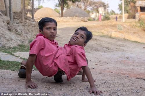 Hermanos unidos por el estómago no se quieren separar jamás (Fotos)