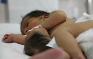 Bebé nace con la cabeza de su hermana gemela pegada al estómago (Fotos)