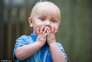 Bebé con extraña condición: Piel escamosa y sin poder parpadear (Fotos)