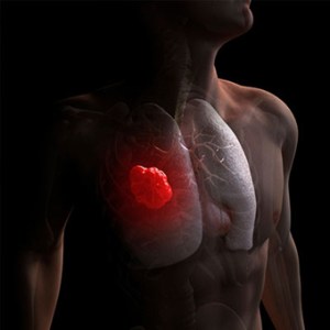 Presentan inmunoterapia más eficaz que “quimio” contra el cáncer de pulmón
