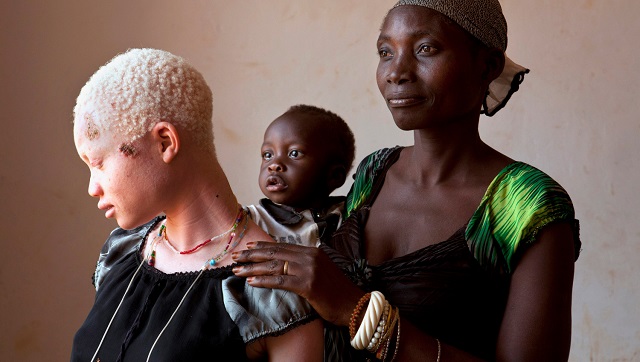 La condena de ser albino en Tanzania