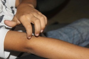 En el estado Lara la falta de productos de higiene aumenta casos de sarna en niños
