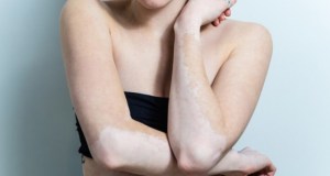 El vitiligo está cada vez más cerca de su curación, según científicos