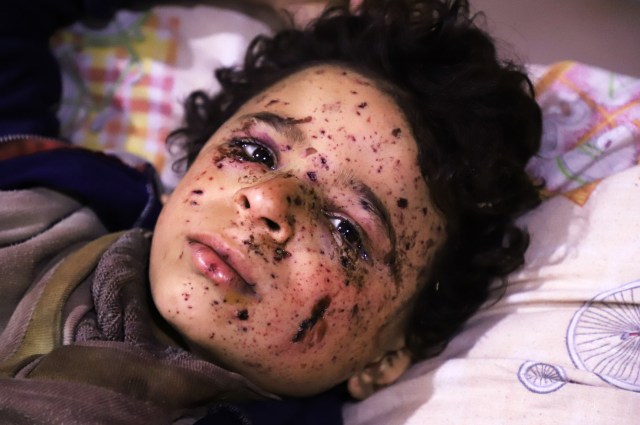 Ten-year-old Omar who was injured in an air strike, that killed several members of his family, on their home in Otaybah receives treatment at a make-shift hospital in Syria's rebel-held enclave of Eastern Ghouta, on February 25, 2018.  / AFP PHOTO / AMER ALMOHIBANY