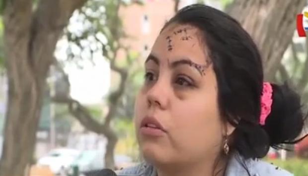 Venezolana quedó desfigurada tras ser atacada por su ex amiga en Perú