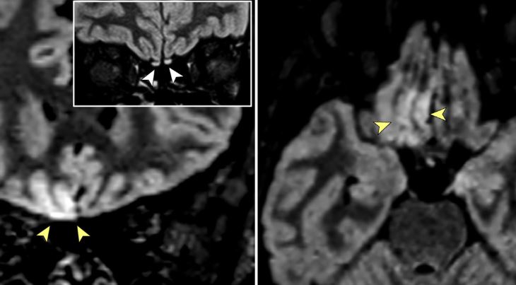 Imágenes de resonancia magnética muestran signos de “invasión cerebral viral” en paciente con Covid-19