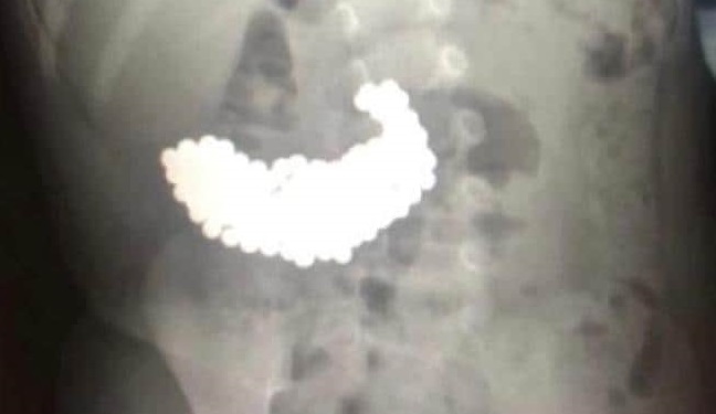 Cirujanos encuentran más de 200 bolas magnéticas en el estómago de una niña rusa (fotos)