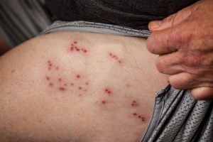 Cómo tratar el herpes Zóster, la “culebrilla” que está causando alarma entre los venezolanos