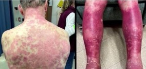 El extraño efecto secundario que sufrió un hombre en la piel tras recibir la vacuna de Johnson & Johnson