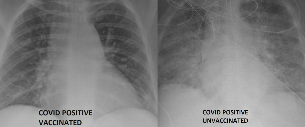 Radiografías de pulmón revelaron diferencias entre un vacunado contra el Covid-19 contagiado y otro sin inoculación (FOTO)