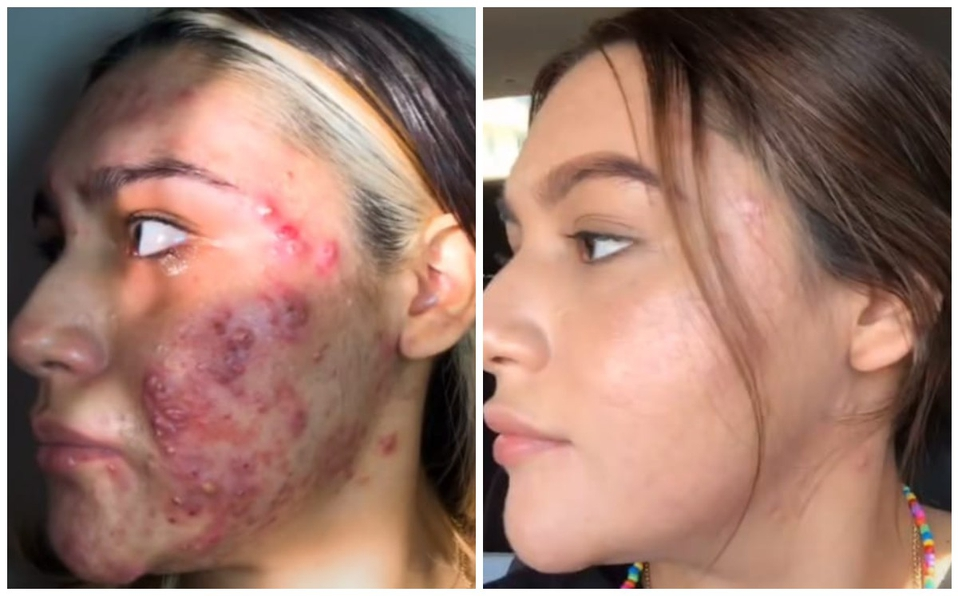 ¡INCREÍBLE! El cambio de una joven que luchó contra el acné e “incendió” TikTok (FOTO + VIDEO)