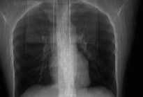Una mujer tosió tan fuerte que se “rompió” por dentro: el llamativo resultado de la tomografía