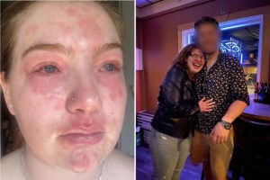 El insólito caso de una mujer en Massachusetts que es alérgica a su novio