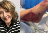 Una mujer se lastimó el pie cortando flores en el jardín y se infectó con un virus carnívoro
